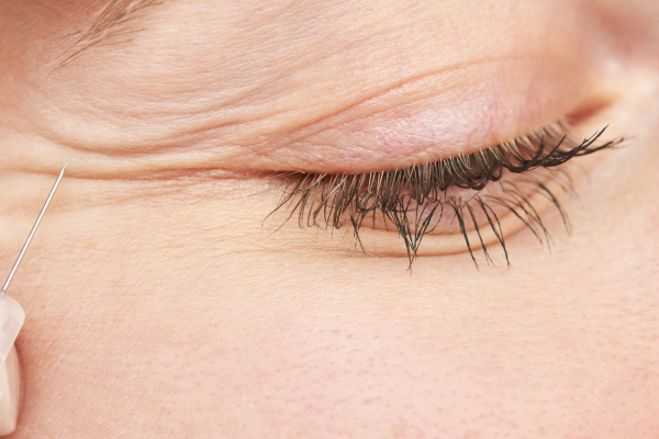 ANTIWRINKLE INJECTIONS in newcastle (1)