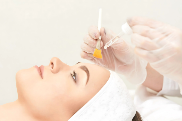 CHEMICAL PEELS IN NEWCASTLE CHEMICAL PEELS IN NEWCASTLE