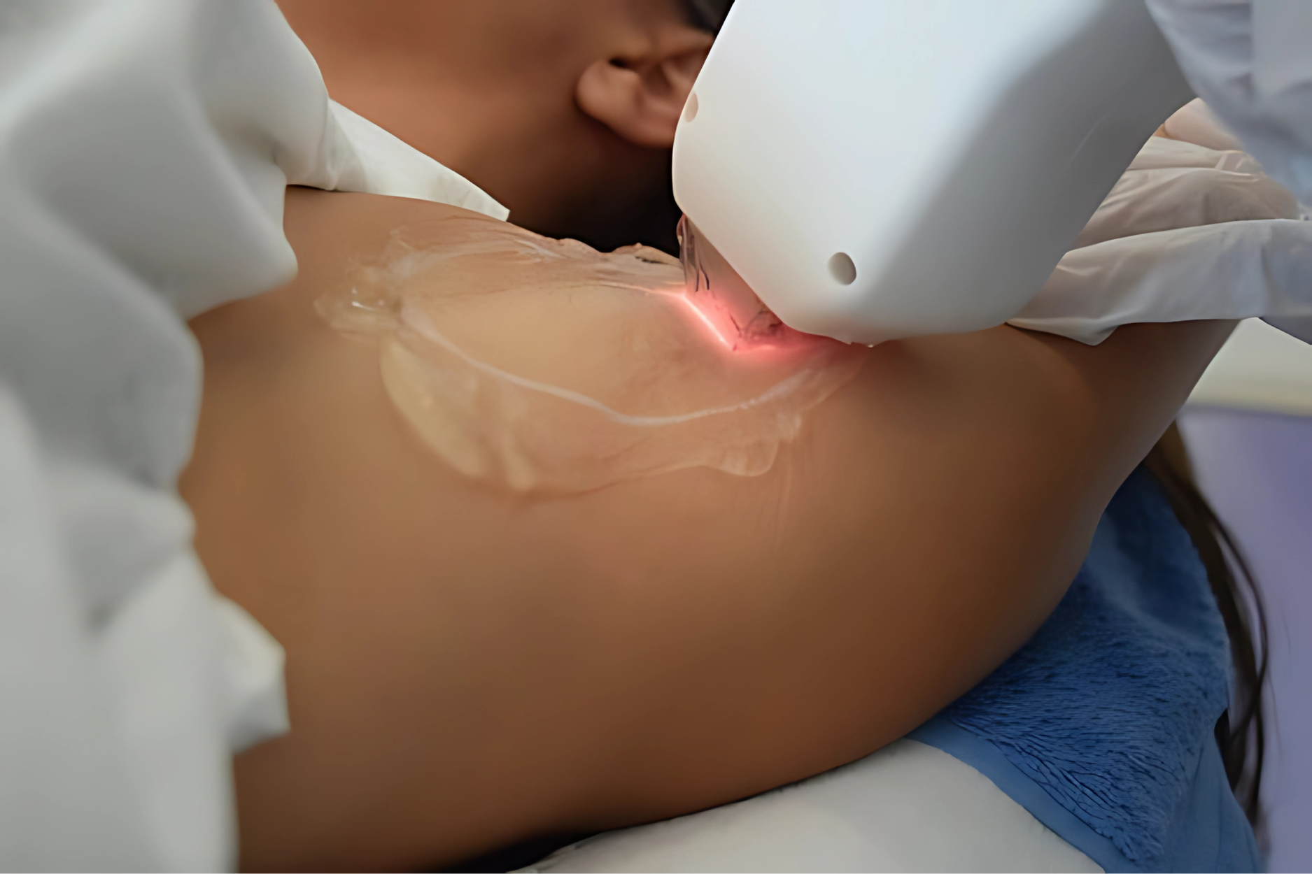 LASER BODY REJUVENATION IN NEWCASTLE LASER BODY REJUVENATION IN NEWCASTLE