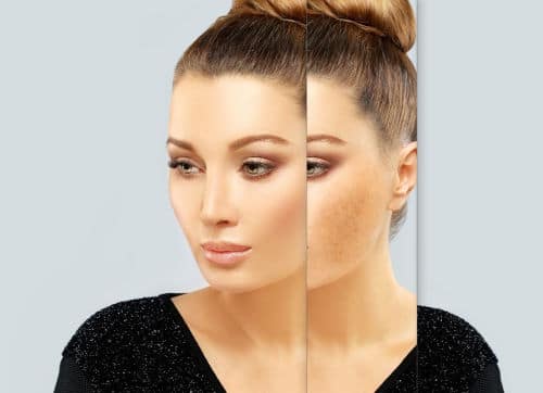 Pigmentation
