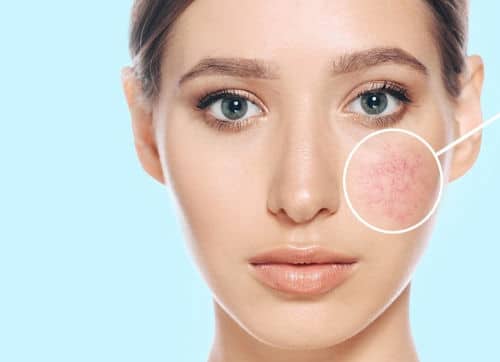 Rosacea