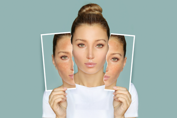 SKIN BOOSTERS IN NEWCASTLE (1) SKIN BOOSTERS IN NEWCASTLE (1)