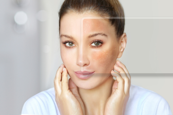 SKIN BOOSTERS IN NEWCASTLE SKIN BOOSTERS IN NEWCASTLE