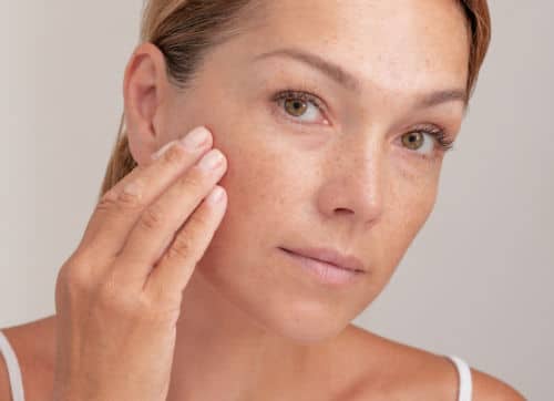 sun damage
